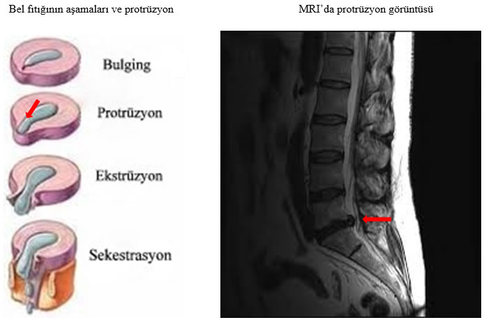 protrüzyon