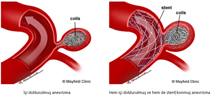 beyinkanamalari2