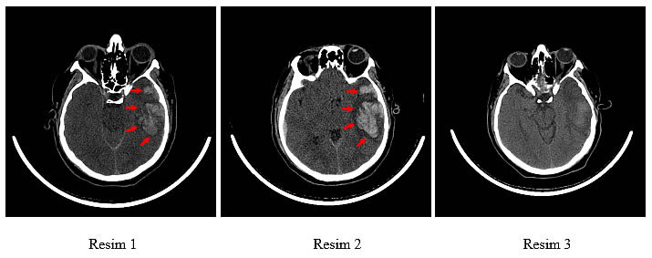 intraserebral Hematom vaka1