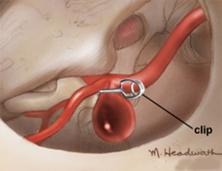 anevrizma3cerrahiyontem