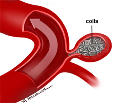 anevrizma4Endovaskuler1